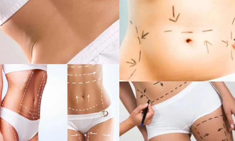 Liposuction Kimlere Yapılır?