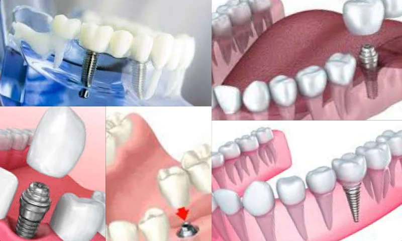 İmplant Tedavi Süreci Nasıl İşliyor?