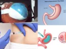 Gastrik Sleeve Ameliyatı Kalıcı Bir Çözüm Müdür?