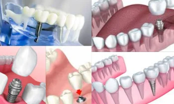 İmplant Tedavi Süreci Nasıl İşliyor?