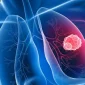 Akciğer Kanserinin Son Evresi 4. Evre Tedavisi Mümkün Müdür?